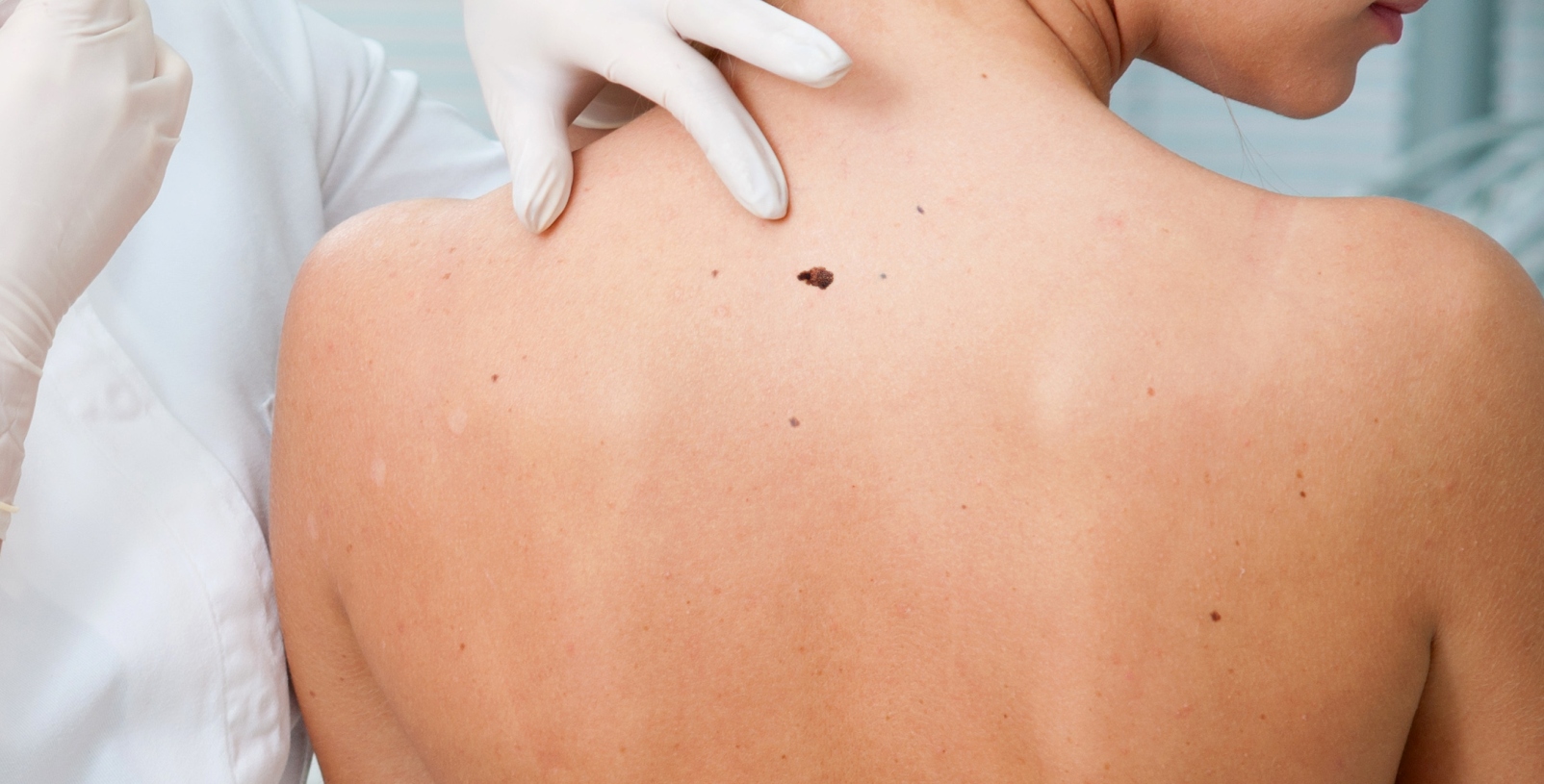 Spot on: Skin Scan rebrands as SkinVision, and now lets you check for signs of skin cancer on Android ...